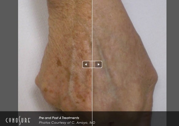 IPL Photofacial Treatment Before and After