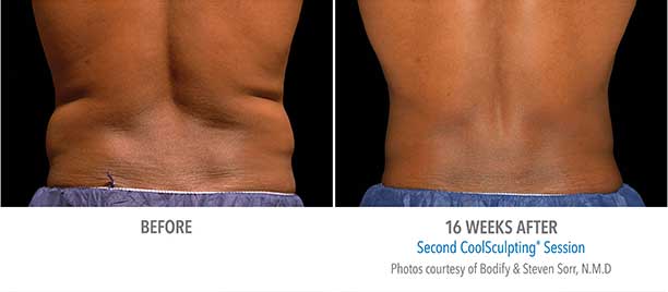 before and after image of CoolSculpting on the lower back region