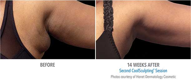 before and after image of CoolSculpting on the upper arms