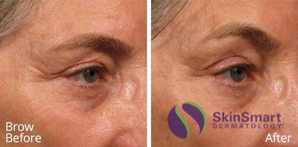 skinsmart-sarasota-dermatologist-ultherapy-brow-before-and-after-01