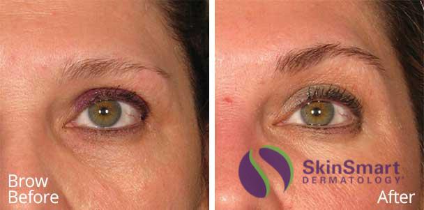 skinsmart-sarasota-dermatologist-ultherapy-brow-before-and-after-02