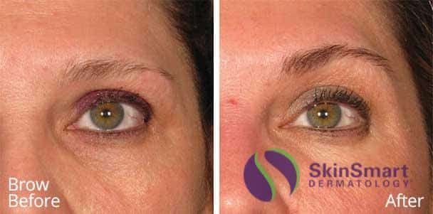 Brow Ultherapy Before and After Sarasota FL Brow Ultherapy Before and After Sarasota FL