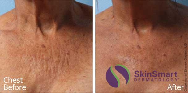 Chest Ultherapy Before and After Sarasota FL Chest Ultherapy Before and After Sarasota FL