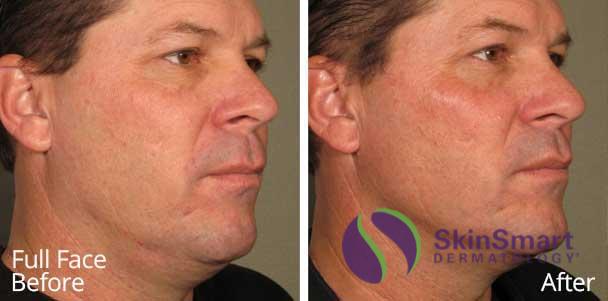 Full Face Ultherapy Before and After Sarasota FL Full Face Ultherapy Before and After Sarasota FL