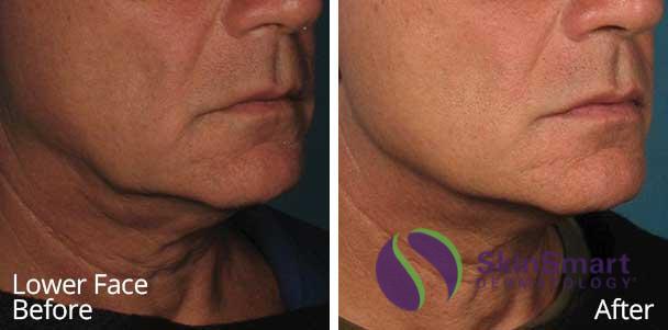 Lower Face Ultherapy Before and After Florida Lower Face Ultherapy Before and After Florida