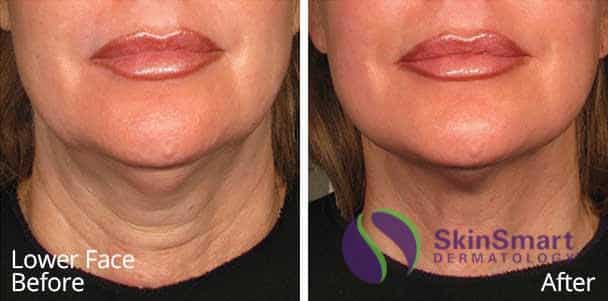 Lower Face Ultherapy Before and After Sarasota FL Lower Face Ultherapy Before and After Sarasota FL