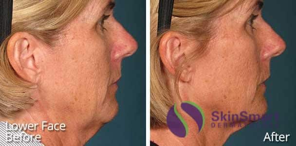 Lower Face Ultrasound Therapy Before and After Sarasota FL Lower Face Ultrasound Therapy Before and After Sarasota FL