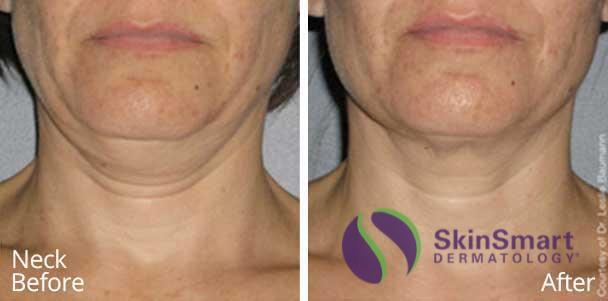 Neck Ultherapy Before and After Sarasota FL Neck Ultherapy Before and After Sarasota FL