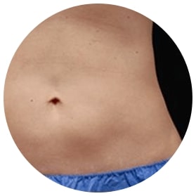 image of a patient's abdomen after coolsculpting showing fat reduction overall