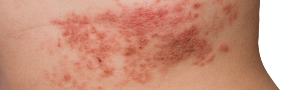 Seborrheic Dermatitis Raleigh Nc