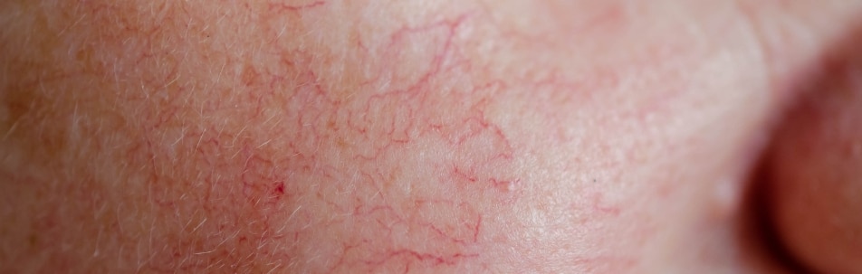 closeup image of a person's face affected by rosacea