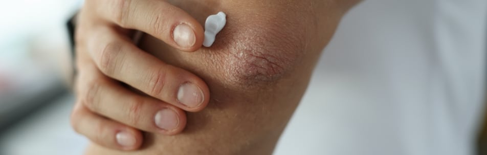 close up image of someone putting psoriasis cream on their elbow