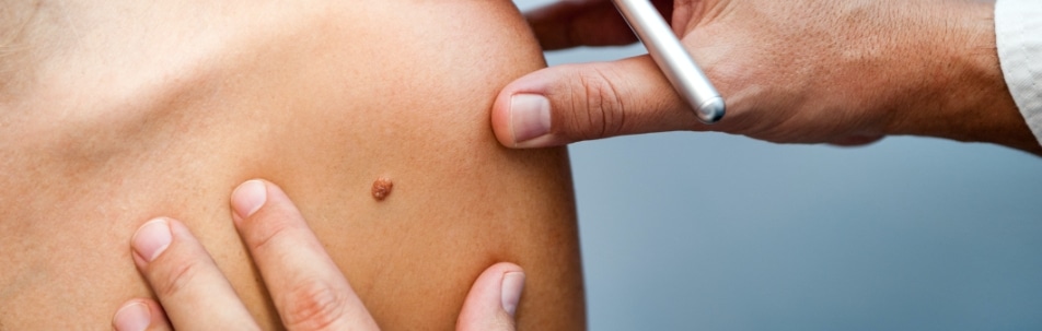 close up image of a mole on someone's shoulder