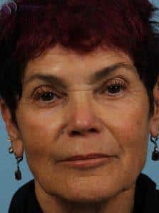 After Image: Restylane