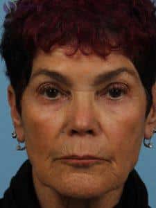 Before Image: Restylane