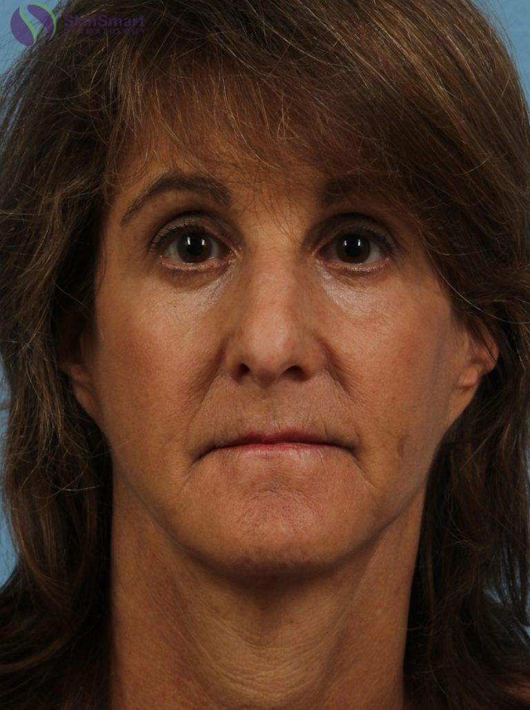 After Image: Restylane - front