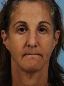 Before Image: Restylane