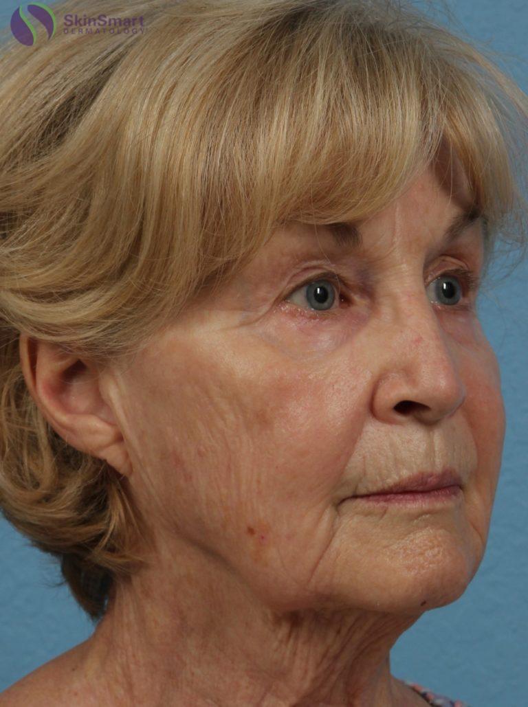 After Image: Co2 Laser - front