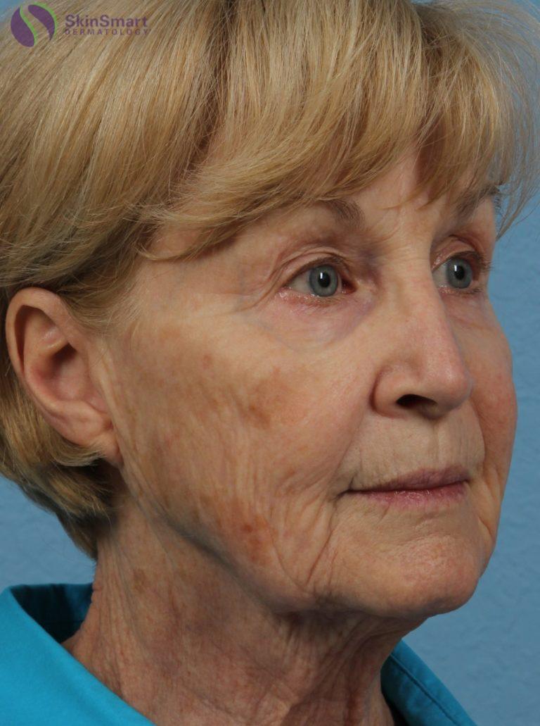 Before Image: Co2 Laser - front