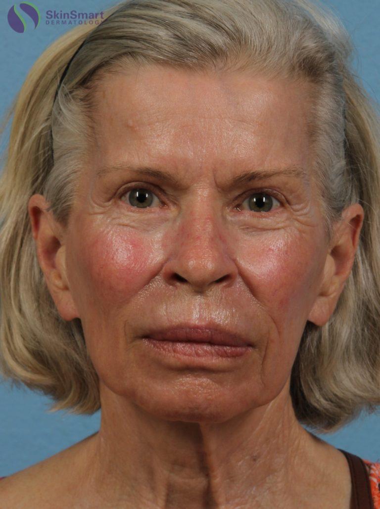After Image: Deka Dot Laser Resurfacing - front