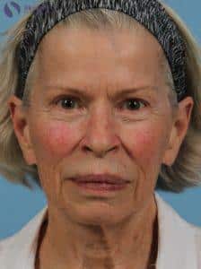 Before Image: Deka Dot Laser Resurfacing
