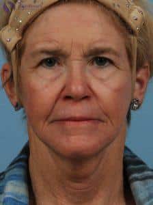 After Image: Deka Dot Laser Resurfacing