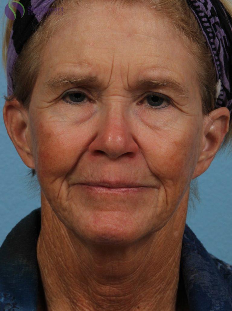 Before Image: Deka Dot Laser Resurfacing - front