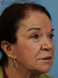 After Image: Dermal Fillers