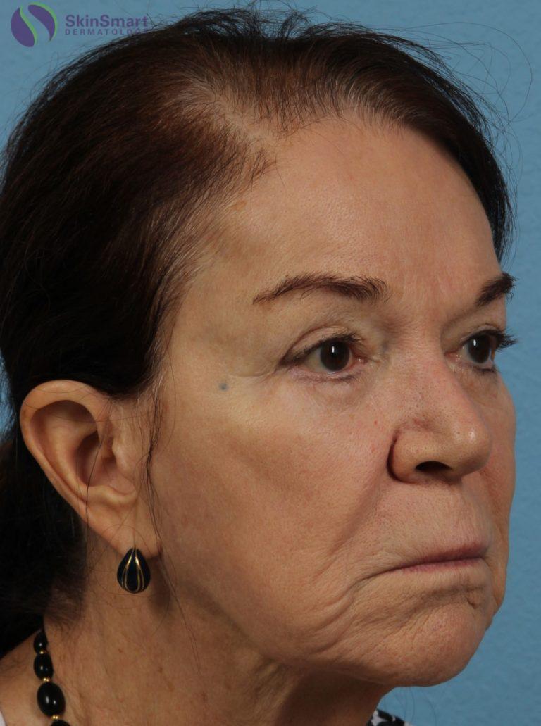 Before Image: Dermal Fillers - front