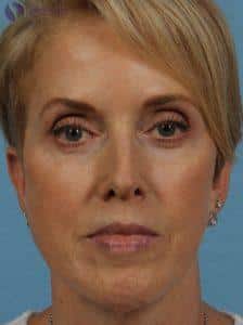 After Image: Dermal Fillers