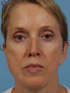 Before Image: Dermal Fillers