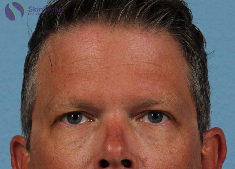 After Image: Under Eye Circles - front