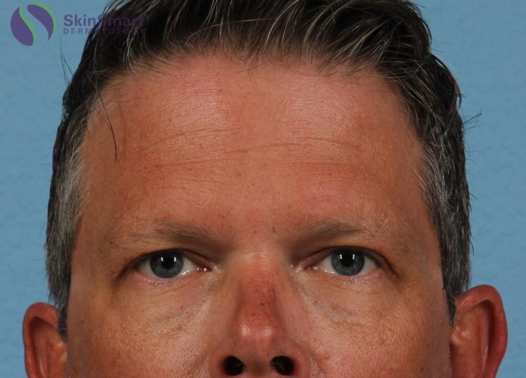 After Image: Under Eye Circles - front
