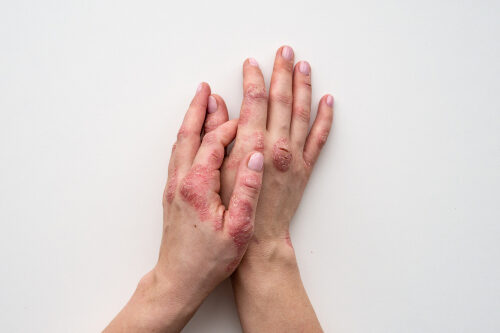 Closeup of rash and scaling on the patients skin