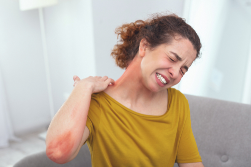 lady in pain looking awfully sick suffering from a spreading skin rash affecting her neck
