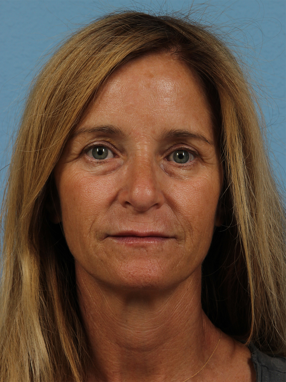 After Image: Restylane - front