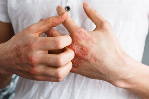 Winter eczema triggers (1)