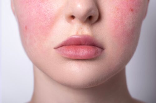 Rosacea,Couperose,Redness,Skin,,Red,Spots,On,Cheeks,,Young,Woman