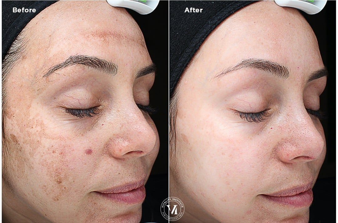 Melasma