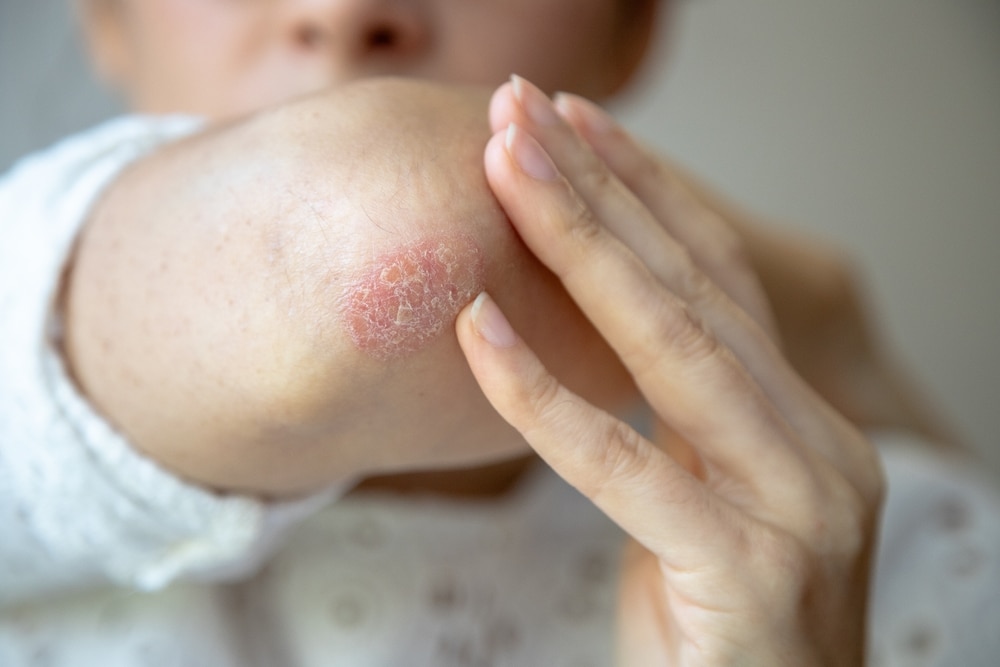 Close-up of a person touching a red, dry patch on their elbow, showing symptoms of psoriasis or eczema needing skin treatment.