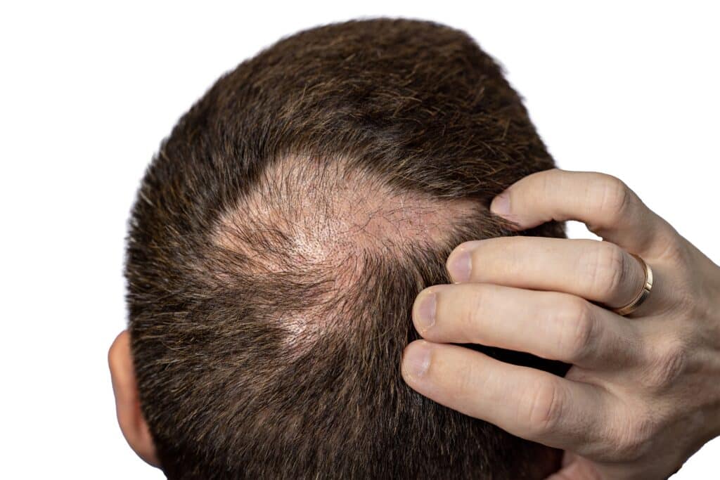 A close-up shows a man’s scalp with thinning hair and bald patches, illustrating the effects of alopecia and hair loss while he scratches his head in frustration